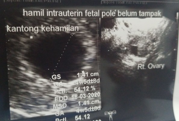 kantong kehamilan 6 weeks